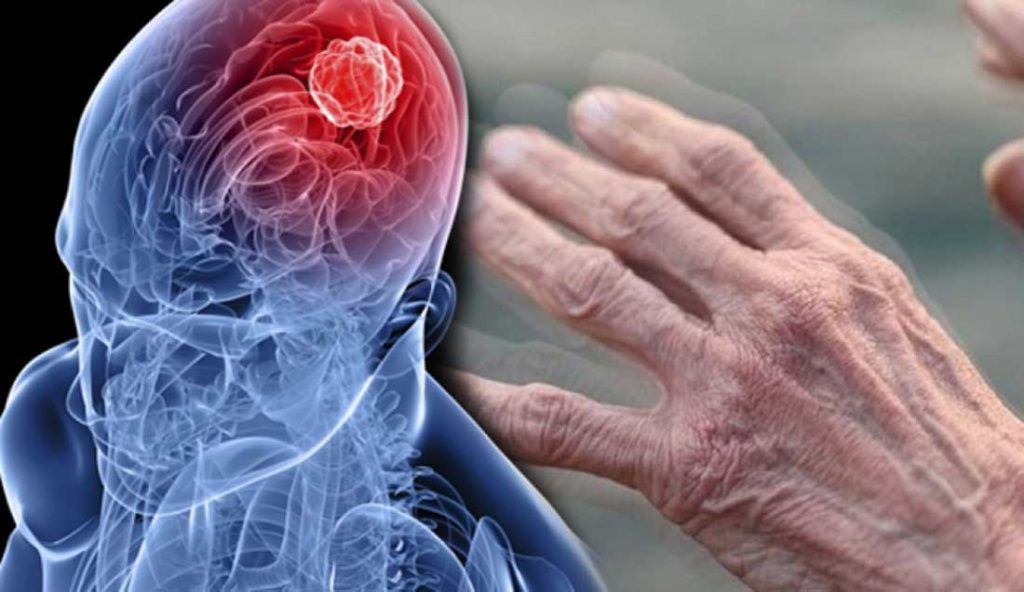 Parkinson Hastalığı: Belirtileri, Nedenleri ve Tedavi Yöntemleri Nelerdir? 